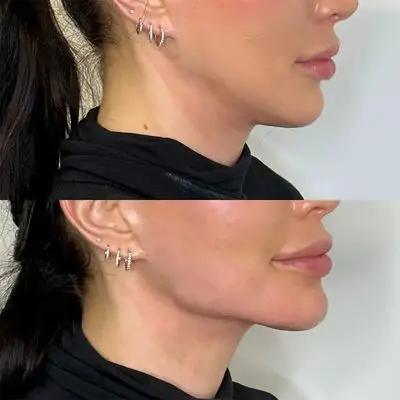 Cheeks, Jawline and Lines Fillers